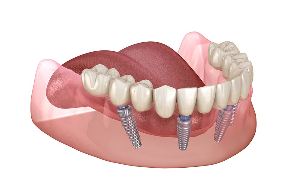 Illustration of a lower dental arch showing a set of teeth supported by four metal implants