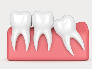 Wisdom Teeth Removal
