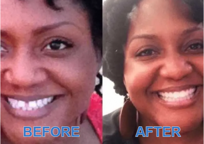 Before and After Images