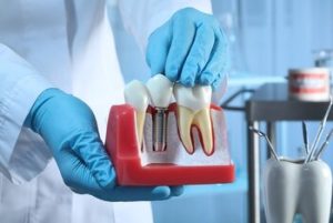 Dental Implants Perth