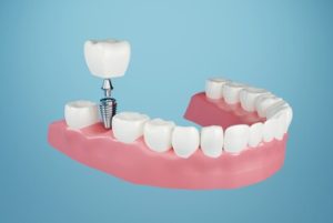 Affordable Dental Implants illustration burwood