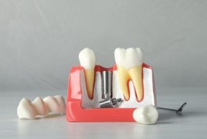 Affordable Dental Implants image burwood
