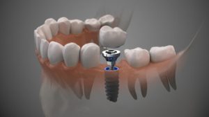 Affordable Dental Implants single burwood