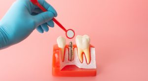 teeth implant philippines burwood