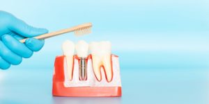 tooth implant overseas burwood