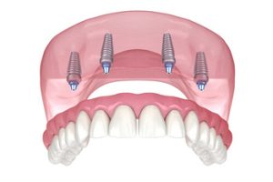 full mouth dental implants cost thailand planning burwood