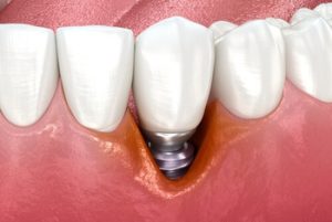 Dental Implants Price Malaysia material