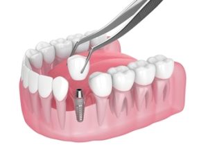 3d,Render,Of,Jaw,With,Dental,Implant,Placement,Over,White