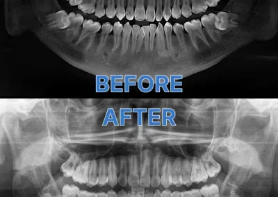Extractions Case 1 Good Choice Dental