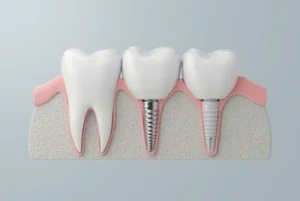 how to relieve pain from dental implant procedure