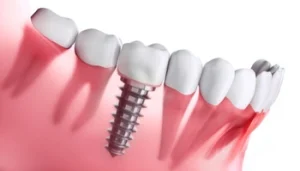 3D rendering of a dental implant screw being placed into the jawbone.