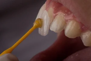 veneers being applied during the process