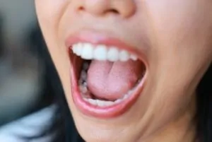 Dos and Don'ts After Wisdom Tooth Extraction decay