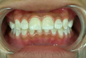 What Are The 4 Causes Of Tooth Decay check