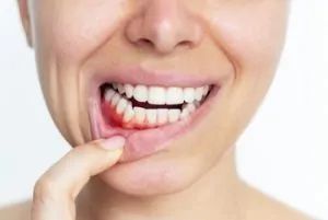 Why Is My Mouth Dry Even Though I Drink a Lot of Water gums